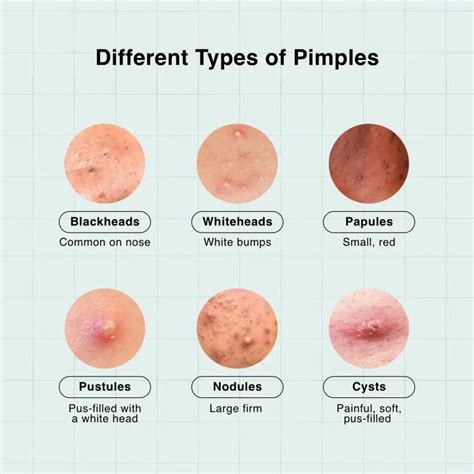 Types of acne and how to get rid of it! | Gallery posted by Kayleigh ...