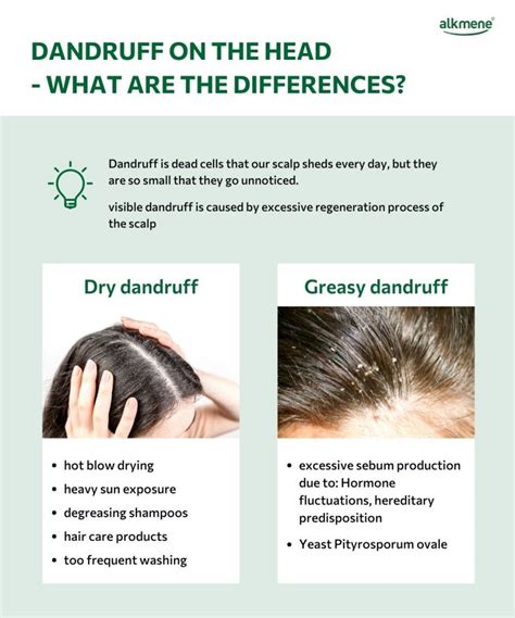 Dandruff - cosmetic problem or skin disease? - alkmene