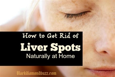 11 Best Way on How to Get Rid of Liver Spots Naturally at Home