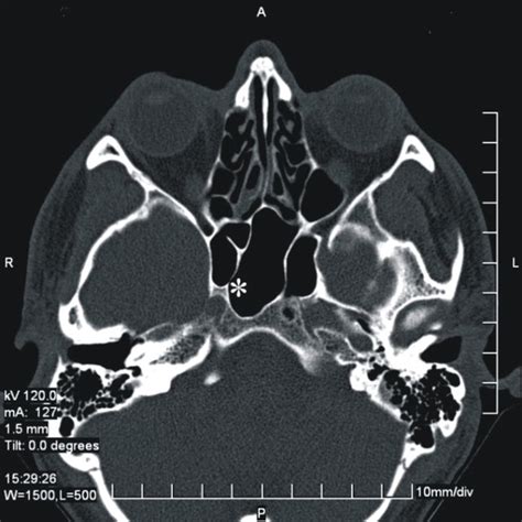 Endoscopic intraoperative endo-sphenoidal view of the right sphenoid ...