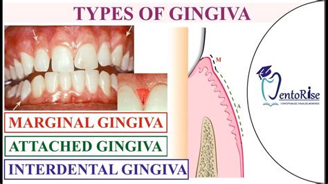 Gingiva anatomy | Gingiva types | Carranza | Marginal Attached ...