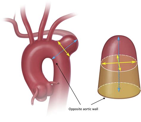 Natural history and management of Kommerell's diverticulum in a single ...