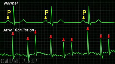 Image Result For Atrial Fibrillation Ecg 1320 | Hot Sex Picture