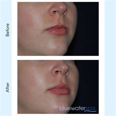 Lip Flip Botox Before And After Photos | Sitelip.org