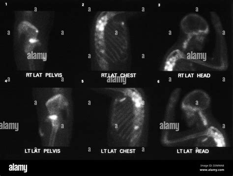 Bone scan for cancer showing multiple metastases to the shoulder, ribs ...