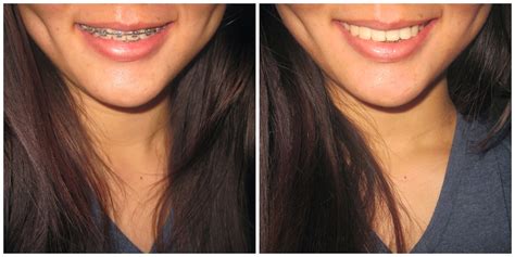 To Flawless: Braces Review (before and after)