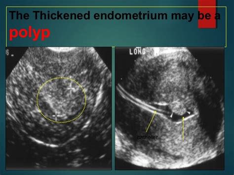 Sonohysterography