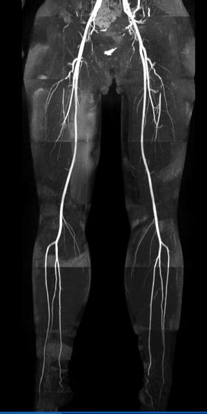 Other MRA methods - Questions and Answers in MRI