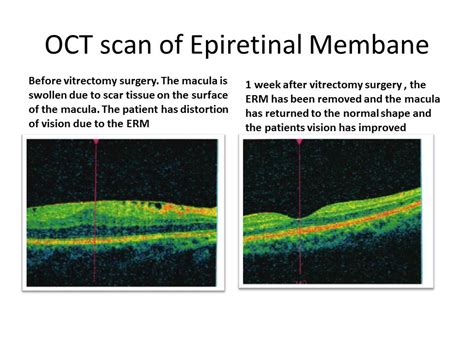 What is an Epiretinal Membrane? | Retina Specialists