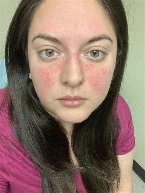 Possible Lupus diagnosis? I’ve had this rash forever but it recently ...