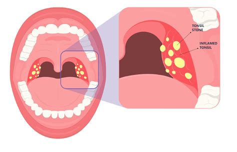 Tonsil Stones: Causes, Symptoms, And Treatment