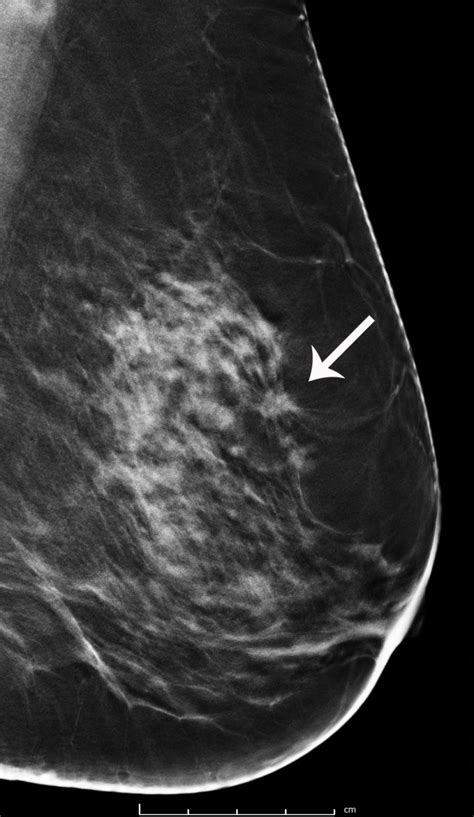 Breast Cancer Screening with 3D Mammography or Tomosynthesis ...