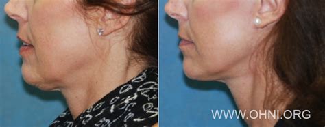 Micro-Mini Lift By Dr. Godin | Minimally-Invasive Facelift