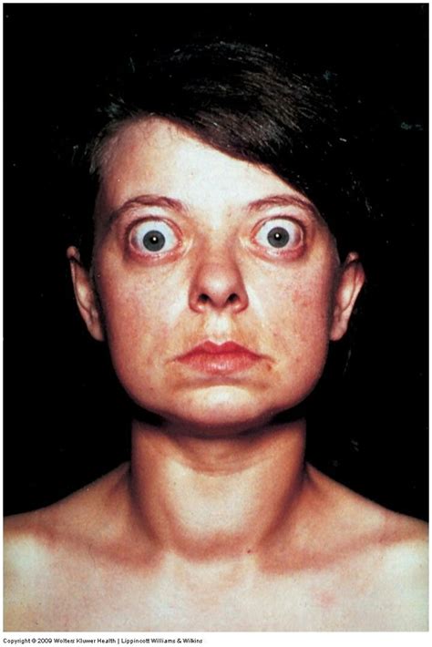 Exophthalmos in Graves disease; when you cannot smile or cry. Your face ...