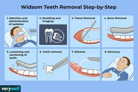 Wisdom Teeth Removal: What to Expect, Recovery, and More