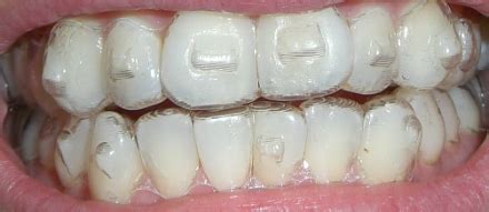 Invisalign Attachments | Riviera Orthodontics