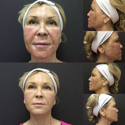 Chemical Peel results comparable to Fraxel Laser - Cynthia Golomb, MD ...