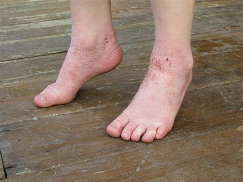 Itchy Rash on Top of Foot: Causes and Treatments | New Health Advisor