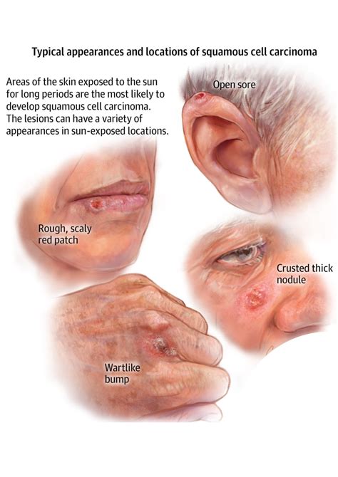 Basal Cell Carcinoma - Richmond Hill Cosmetic Clinic