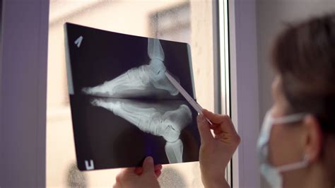 Doctor Examines X-ray Film Of Broken Foot Stock Footage SBV-347481502 ...