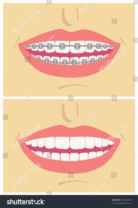 Smile Before After Wearing Braces Correctingvector Stock Vector ...