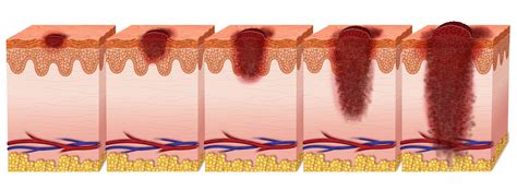 What Each Melanoma Stage Means