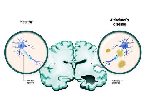 aluminum and alzheimer's Archives - Family Health Advocacy