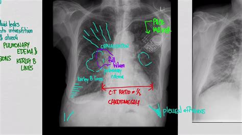 CXR Congestive Heart Failure (CHF) - YouTube