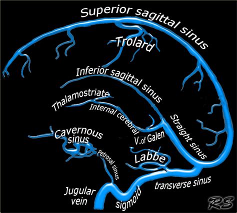 The Radiology Assistant : Cerebral Venous Thrombosis