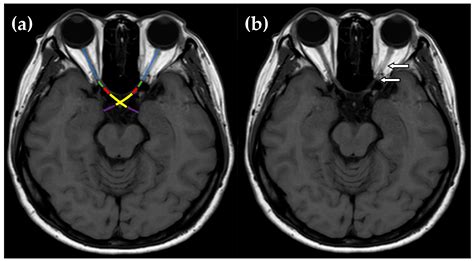 A 10-Year Single-Center Study of the Clinical Characteristics of Optic ...