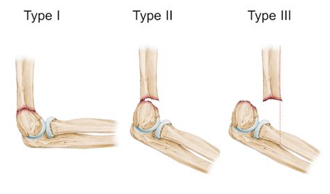 Distal humerus fracture