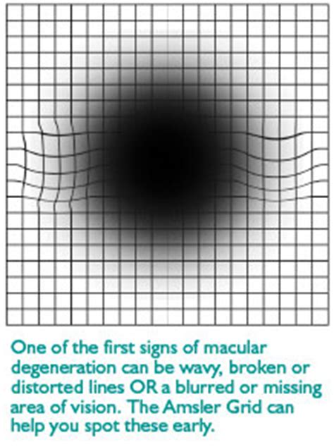 Macular Degeneration | Rand Eye Institute