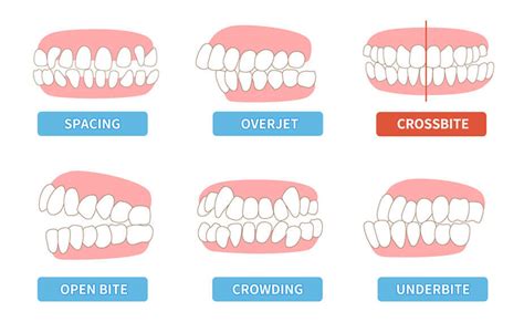 Crossbite Teeth