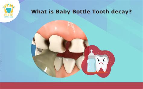 What is baby bottle tooth decay? - Elite Dental Care