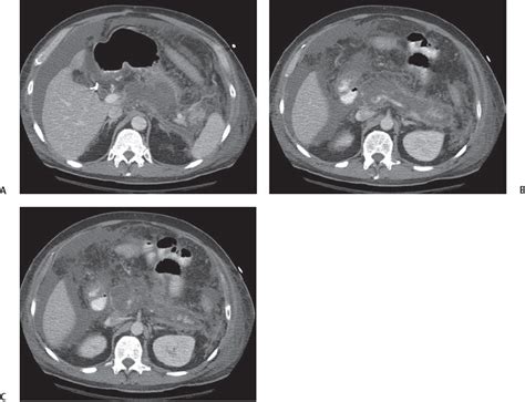 26 Acute Necrotizing Pancreatitis | Radiology Key