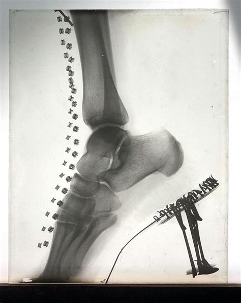 RARE GLASS X-RAY WOMAN'S FOOT INSIDE VICTORIAN SHOE - RARE MEDICAL ...