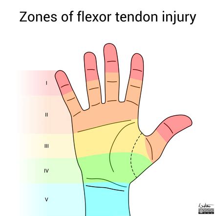 Zones Of Flexor Tendon Injury Illustration Radiology Case | The Best ...