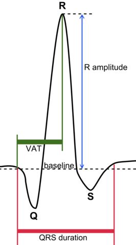 How to measure QRS complex? | Homework.Study.com