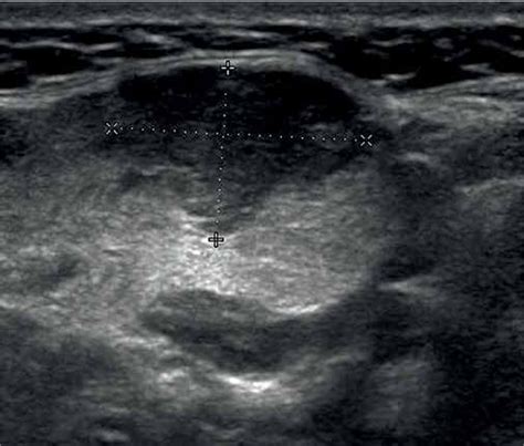 Heterogeneous Submandibular Gland Ultrasound