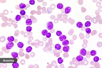 CLL Stages and Treatment Explained With Pictures