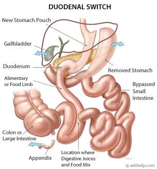 Duodenal Switch Bariatric Surgery