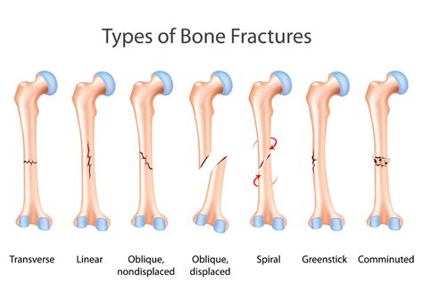 Explain the Difference Between a Fracture and a Broken Bone - Case-has ...