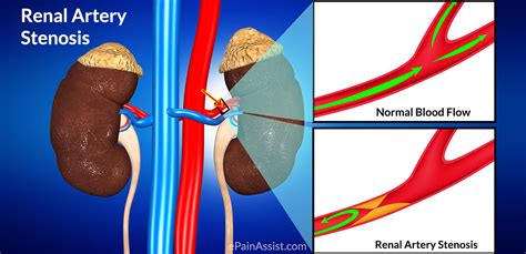 Renal Artery Stenosis (RAS): Treatment, Causes, Symptoms