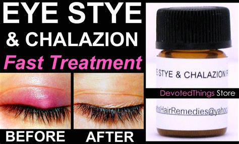 FAST Eye Stye Treatment and Chalazion Treatment 2 in 1 Product