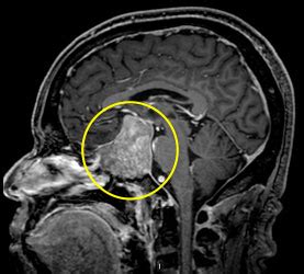 Pituitary Tumor Mri