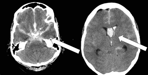 Cureus | Management of Poor-Grade Aneurysmal Subarachnoid Hemorrhage ...