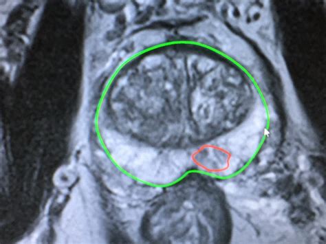 Prostate MRI and New Biopsy Techniques