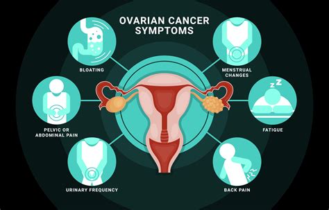 Ovarian Cancer Symptoms Infographic 3107732 Vector Art at Vecteezy