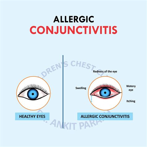 Allergic Conjunctivitis or Eye Allergy - Dr. Ankit Parakh