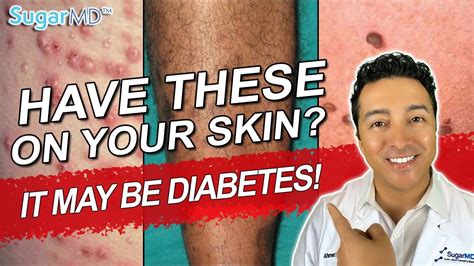 12 Diabetic Skin Problems & Top Signs of Diabetes on The Skin! - YouTube